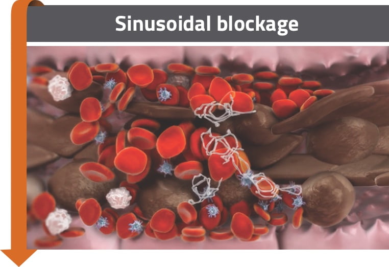Sinusoidal blockage