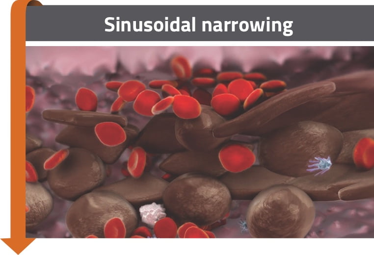 Sinusoidal narrowing